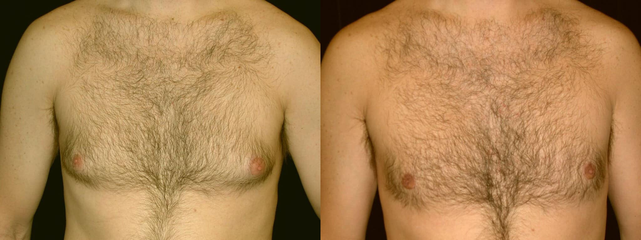 Gynecomastia Patient 3 Before & After