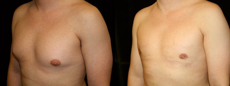 Gynecomastia Patient 16 Before & After Details