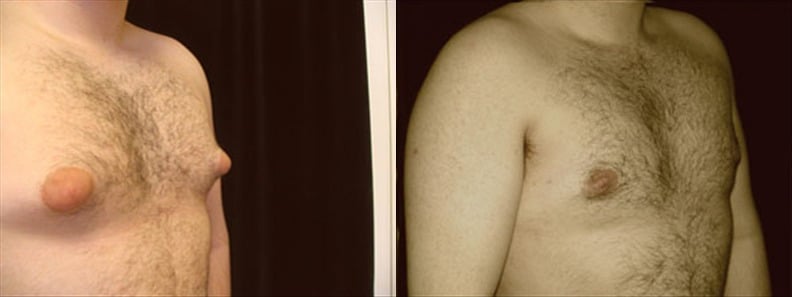 Gynecomastia Patient 3 Before & After Details