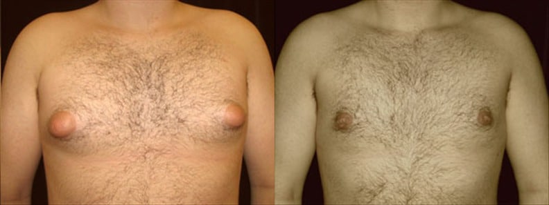 Gynecomastia Patient 3 Before & After