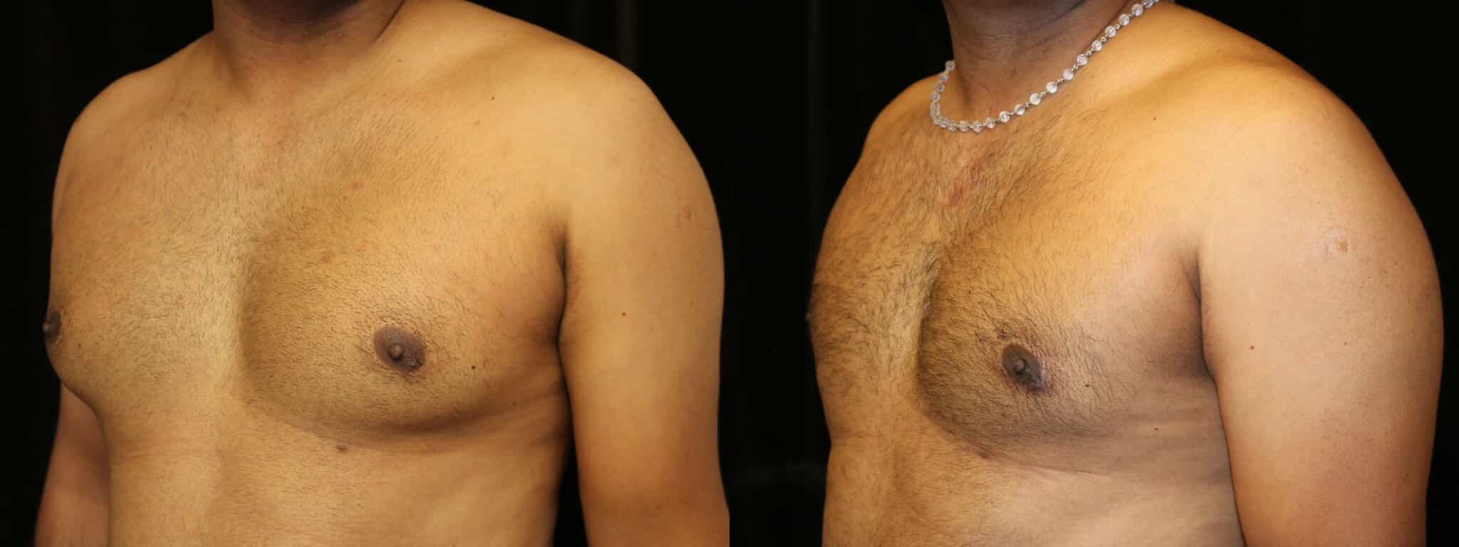 Gynecomastia Patient 19 Before & After Details