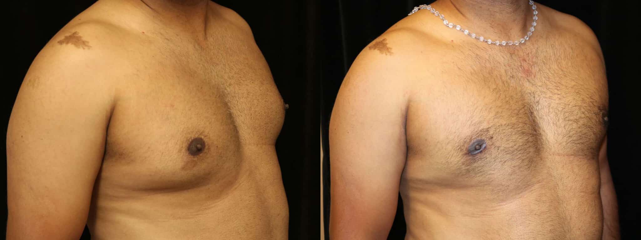 Gynecomastia Patient 19 Before & After Details