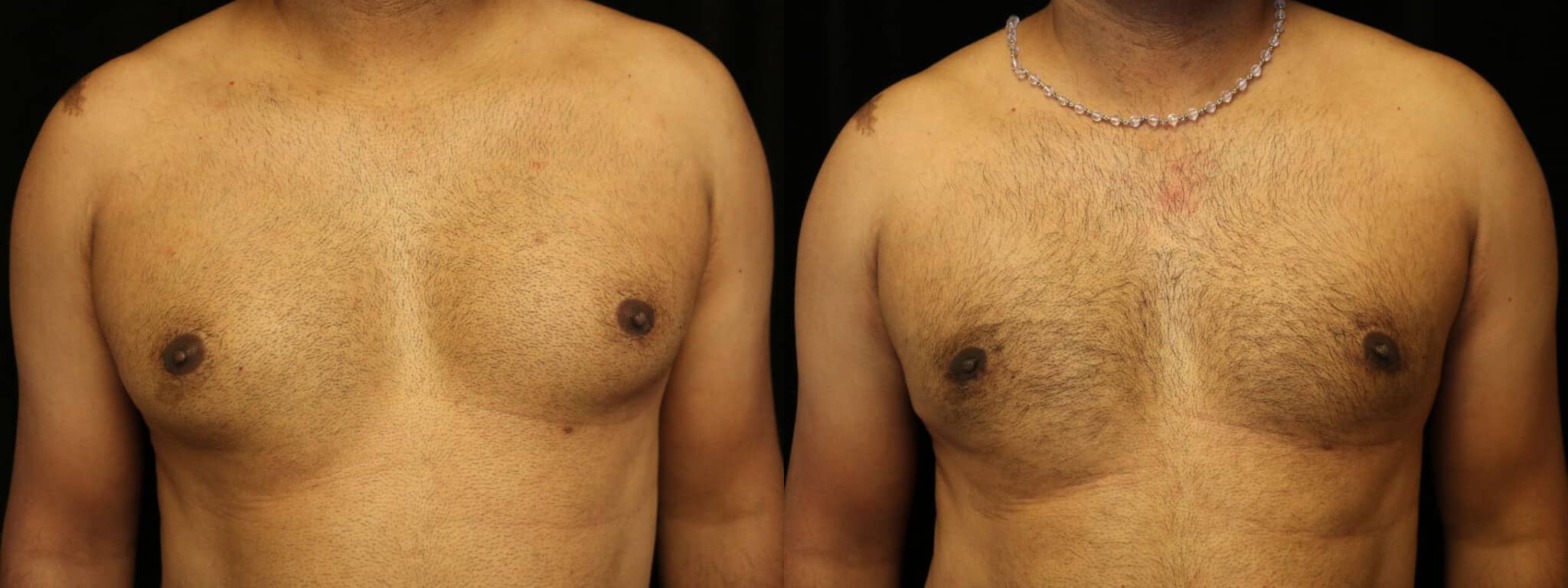 Gynecomastia Patient 19 Before & After