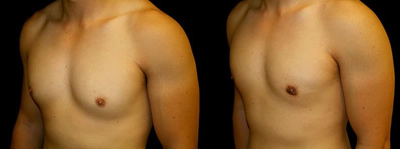 Gynecomastia Patient 2 Before & After Details