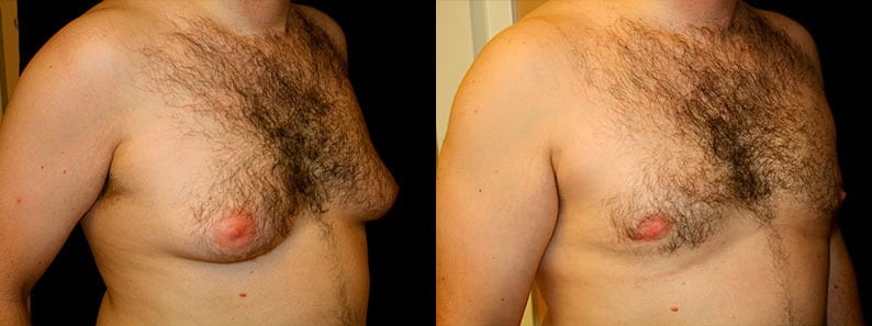 Gynecomastia Patient 8 Before & After Details