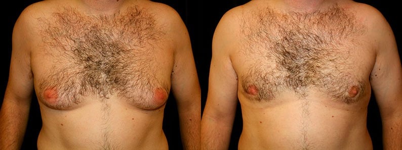 Gynecomastia Patient 8 Before & After