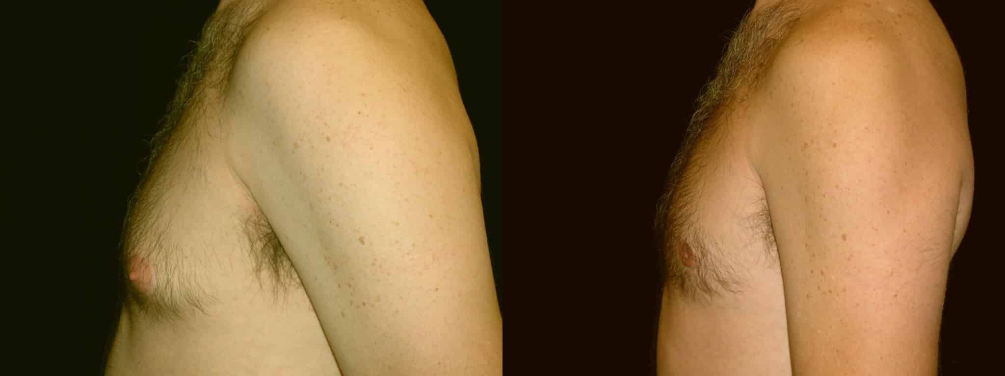 Gynecomastia Patient 3 Before & After Details