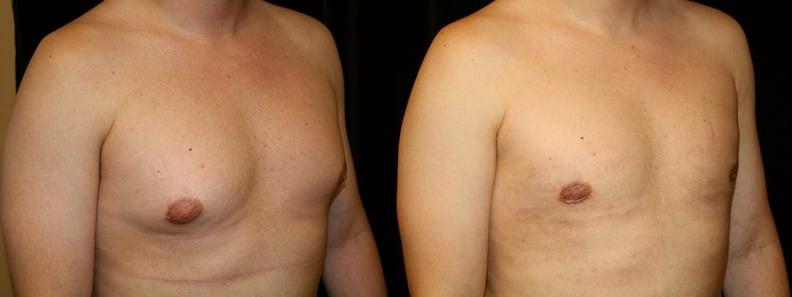 Gynecomastia Patient 16 Before & After Details