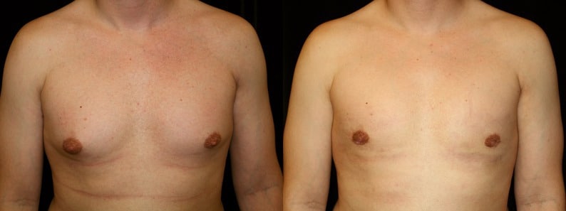 Gynecomastia Patient 16 Before & After