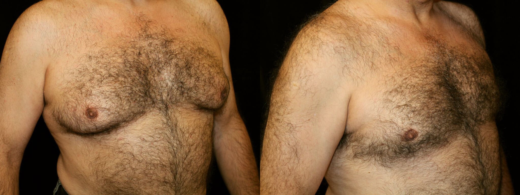 Gynecomastia Patient 5 Before & After Details