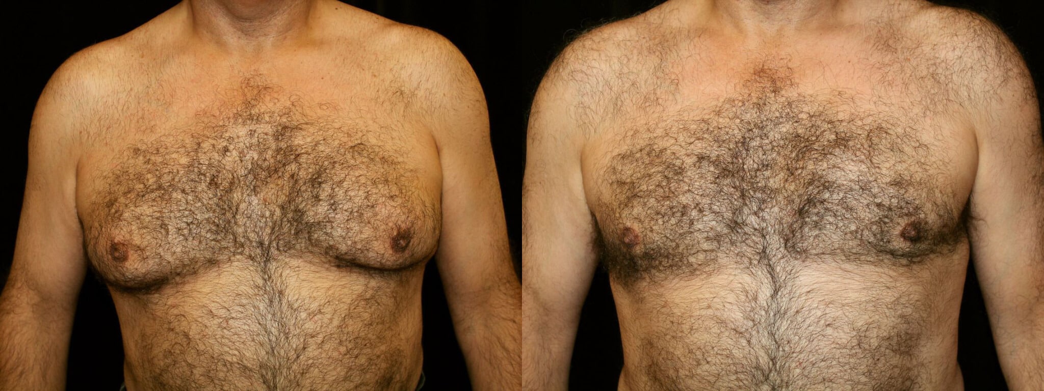 Gynecomastia Patient 5 Before & After