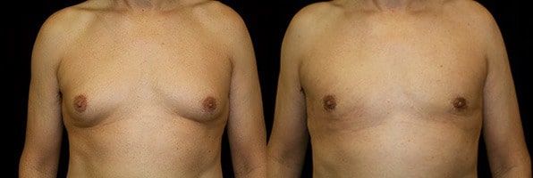 Gynecomastia Patient 18 Before & After