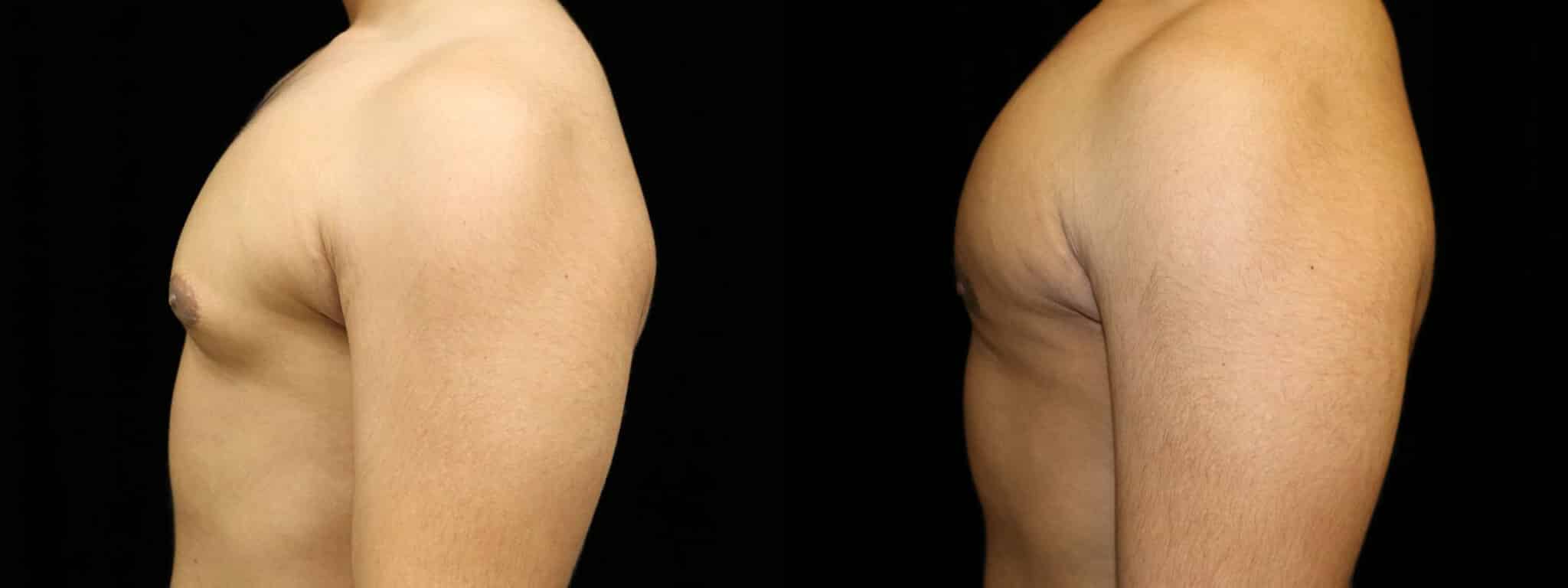 Gynecomastia Patient 15 Before & After Details