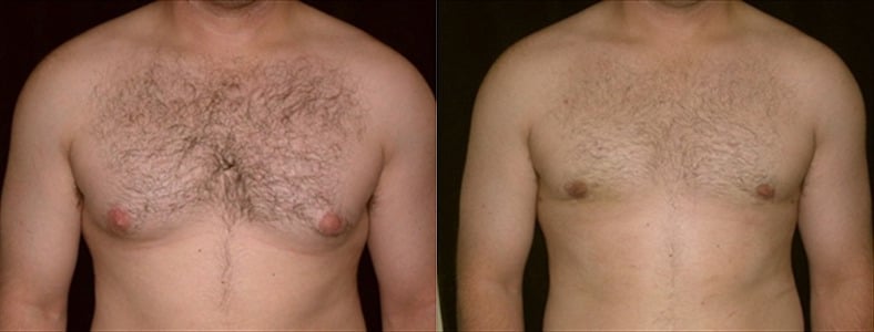 Gynecomastia Patient 15 Before & After