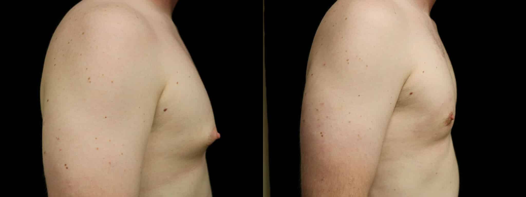 Gynecomastia Patient 21 Before & After Details