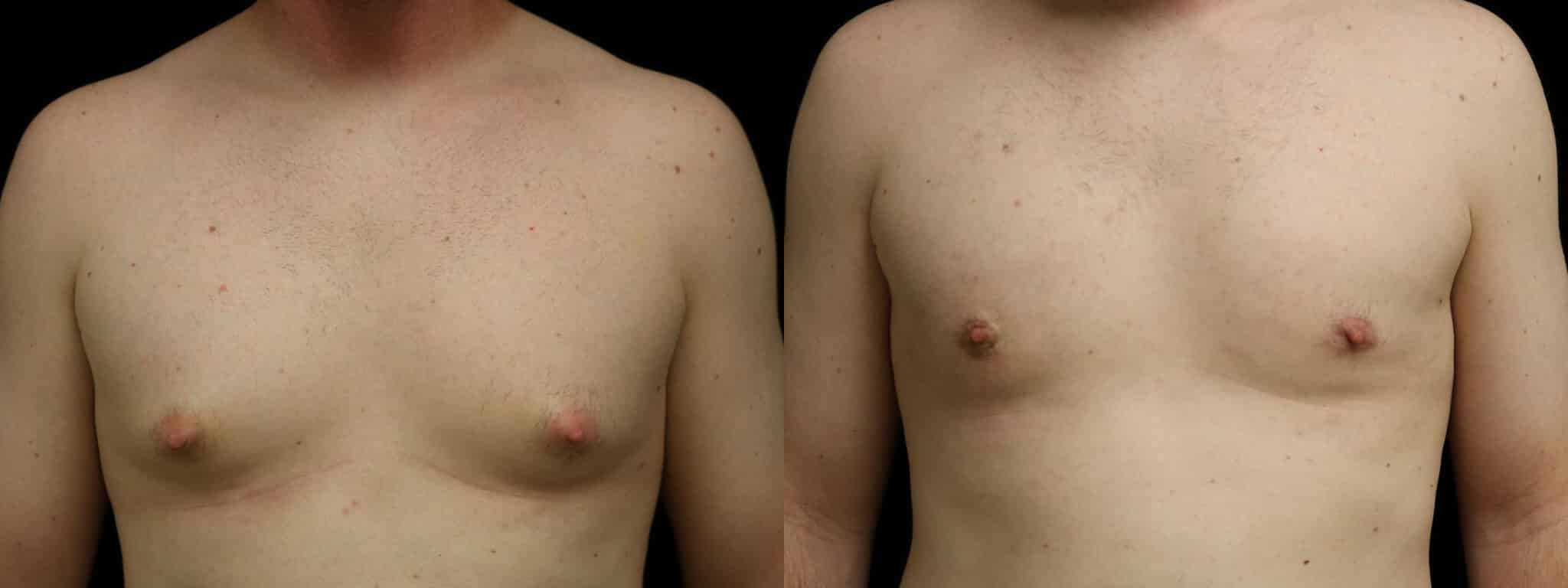 Gynecomastia Patient 21 Before & After