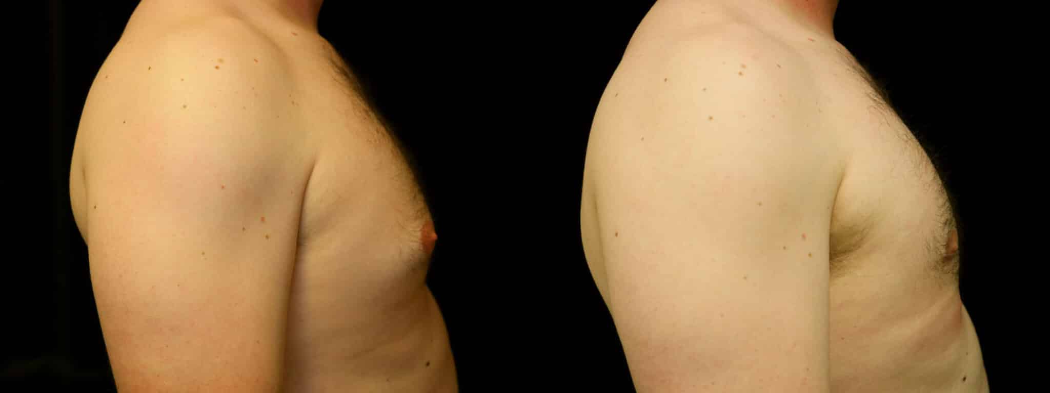 Gynecomastia Patient 5 Before & After Details