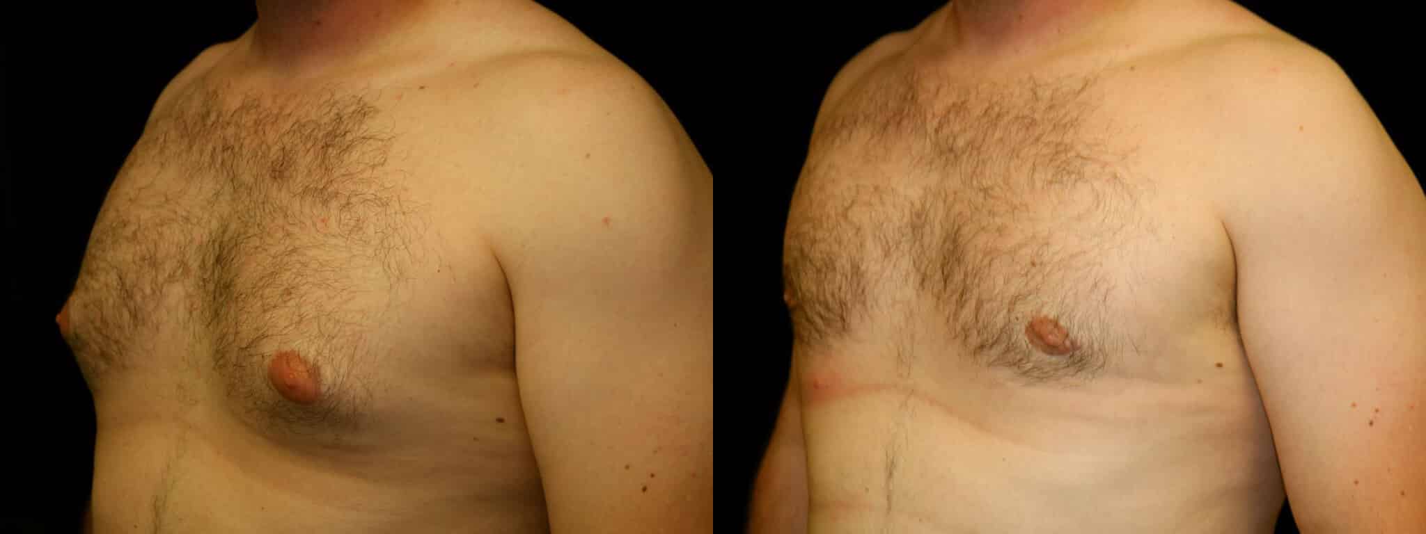 Gynecomastia Patient 5 Before & After Details