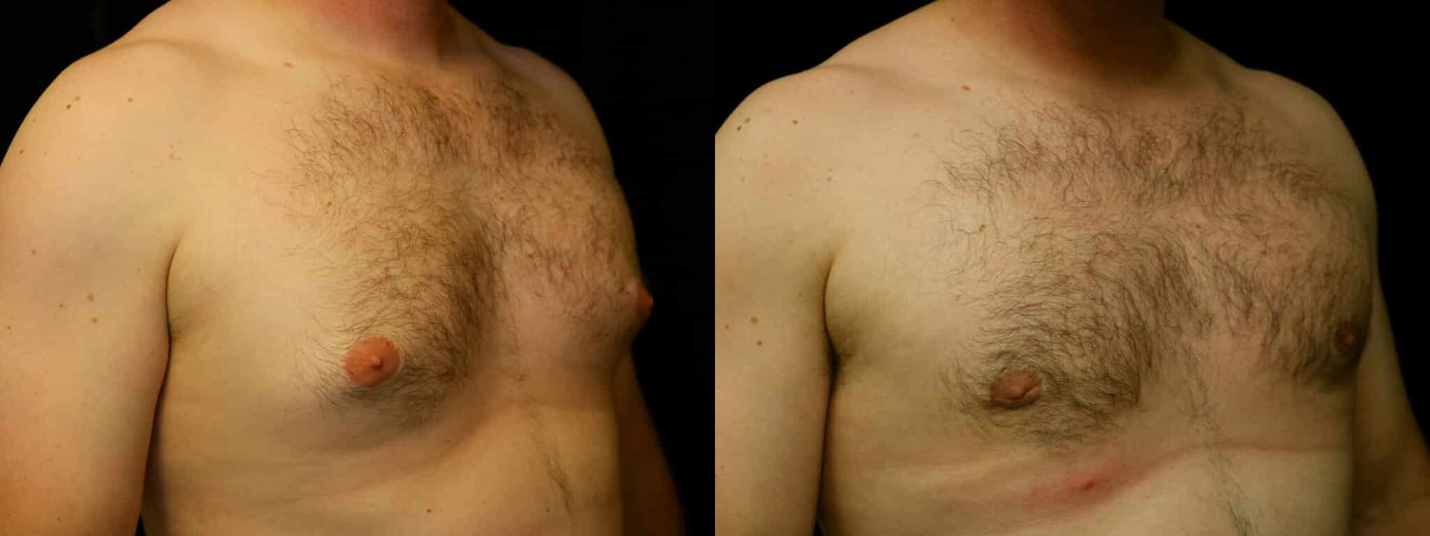 Gynecomastia Patient 5 Before & After Details