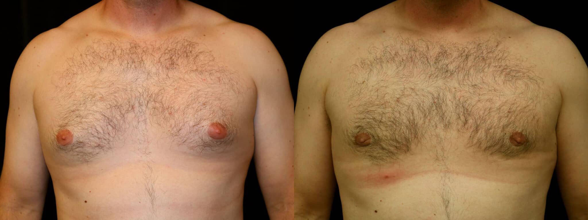 Gynecomastia Patient 5 Before & After