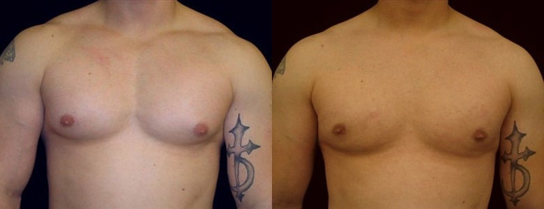 Gynecomastia Patient 16 Before & After