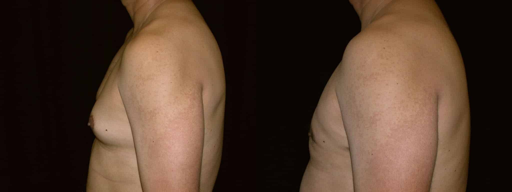 Gynecomastia Patient 9 Before & After Details