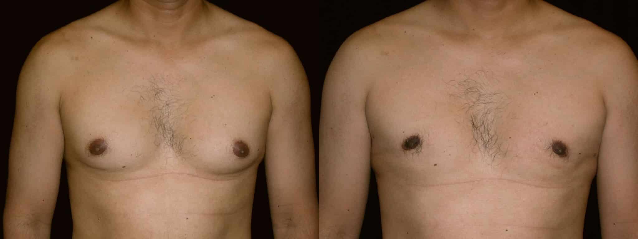 Gynecomastia Patient 9 Before & After