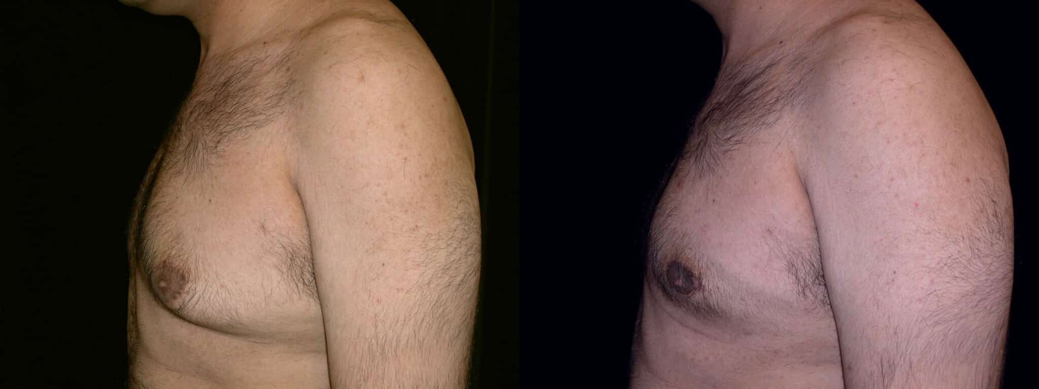 Gynecomastia Patient 2 Before & After Details