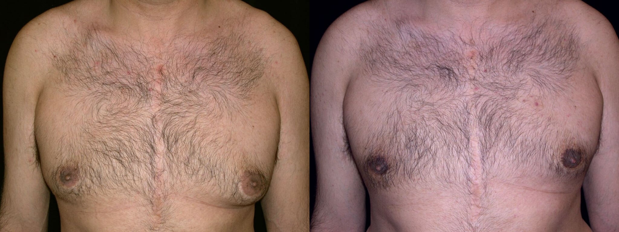 Gynecomastia Patient 2 Before & After