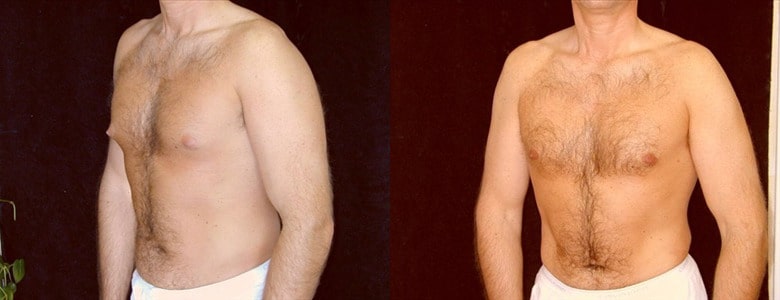 Gynecomastia Patient 13 Before & After