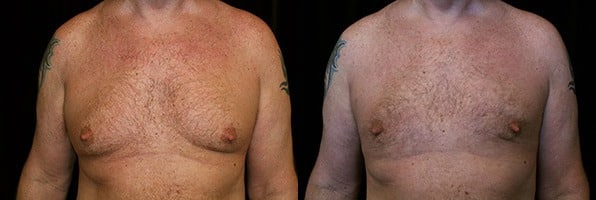 Gynecomastia Patient 7 Before & After