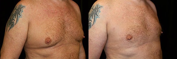 Gynecomastia Patient 7 Before & After Details