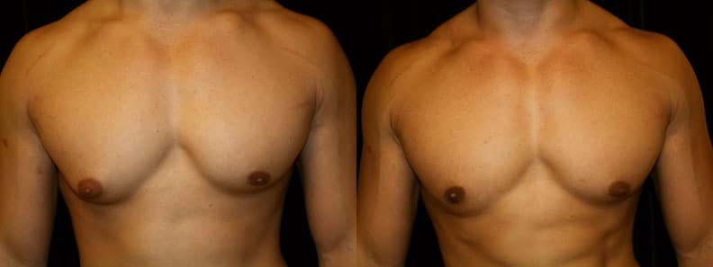 Gynecomastia Patient 11 Before & After