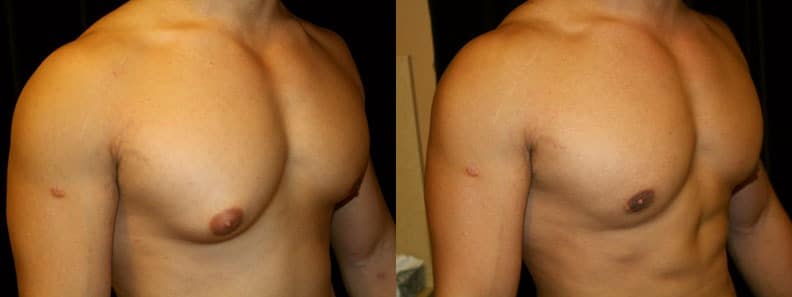 Gynecomastia Patient 11 Before & After Details