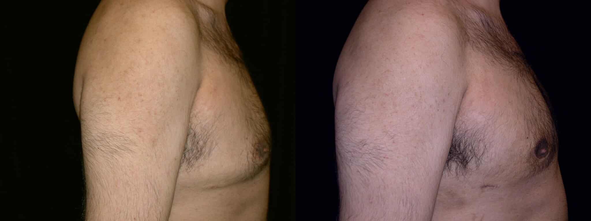 Gynecomastia Patient 2 Before & After Details