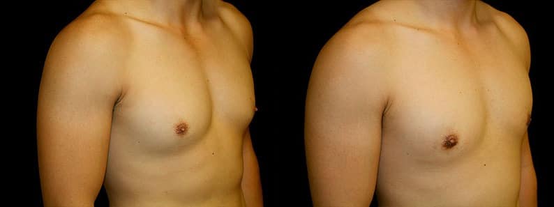 Gynecomastia Patient 2 Before & After Details