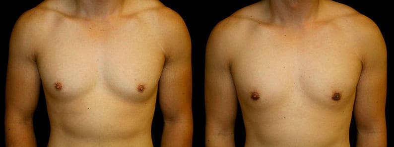 Gynecomastia Patient 2 Before & After