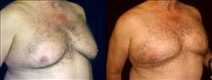 Gynecomastia Patient 6 Before & After