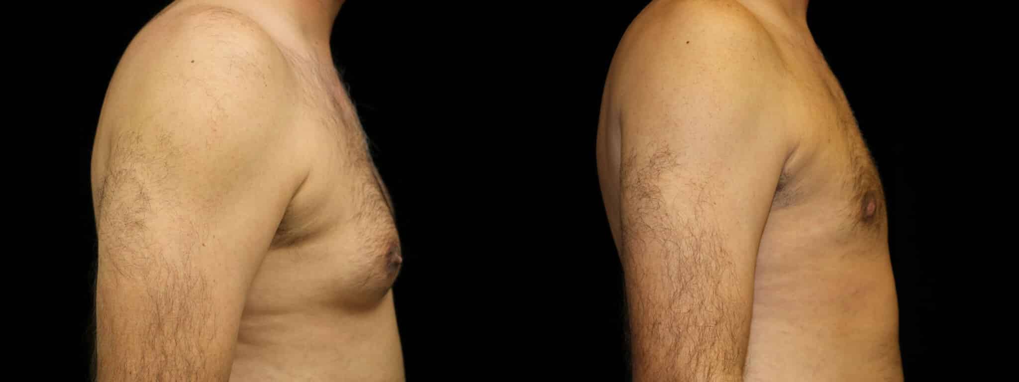 Gynecomastia Patient 1 Before & After Details