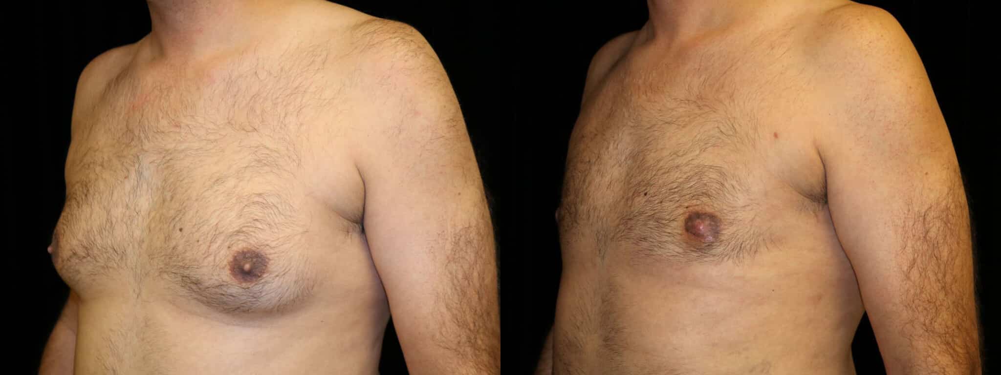 Gynecomastia Patient 1 Before & After Details