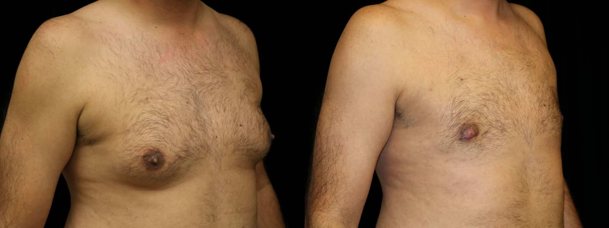 Gynecomastia Patient 1 Before & After Details