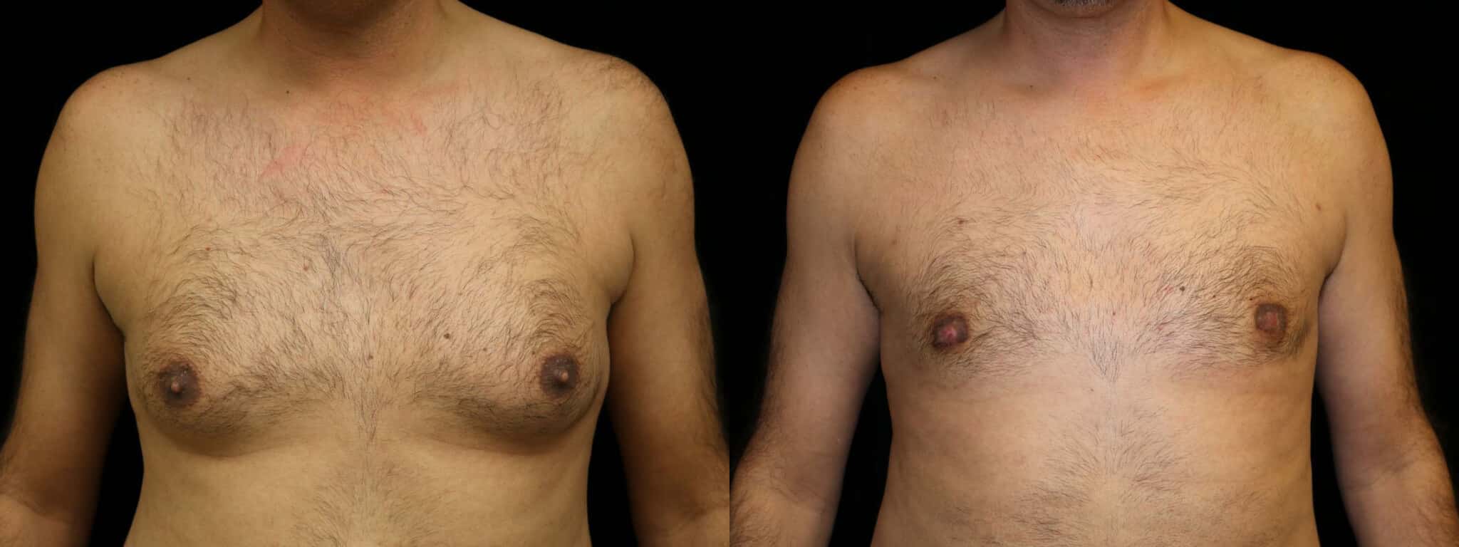 Gynecomastia Patient 1 Before & After