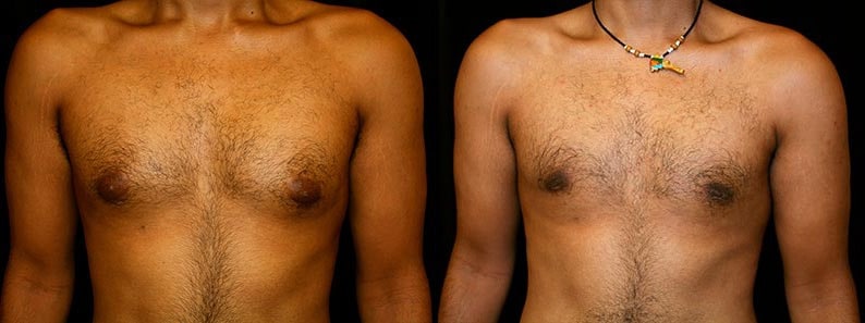Gynecomastia Patient 17 Before & After