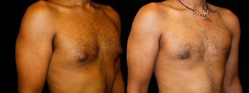 Gynecomastia Patient 17 Before & After Details