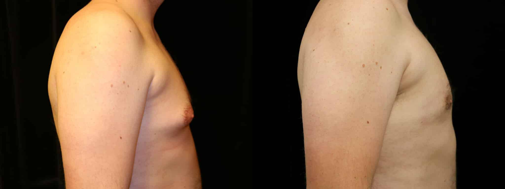 Gynecomastia Patient 15 Before & After Details