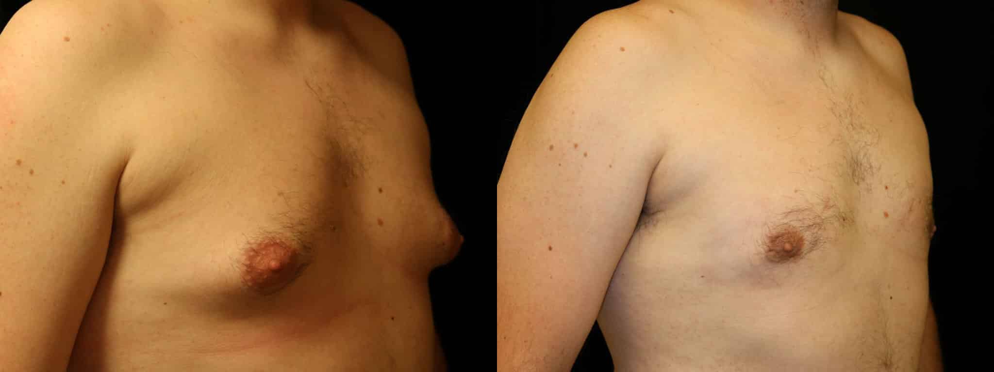 Gynecomastia Patient 15 Before & After Details