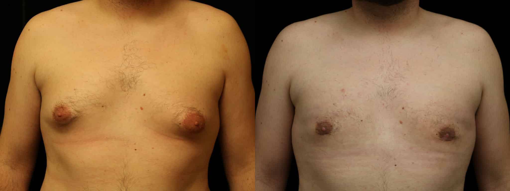 Gynecomastia Patient 15 Before & After