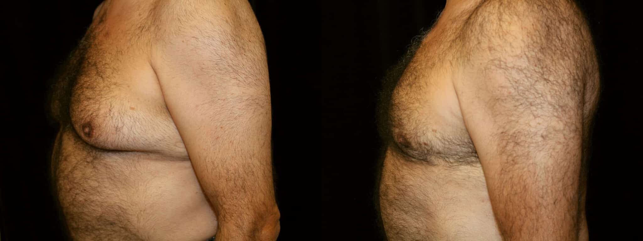 Gynecomastia Patient 5 Before & After Details