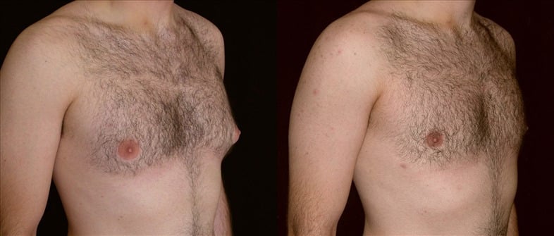 Gynecomastia Patient 21 Before & After