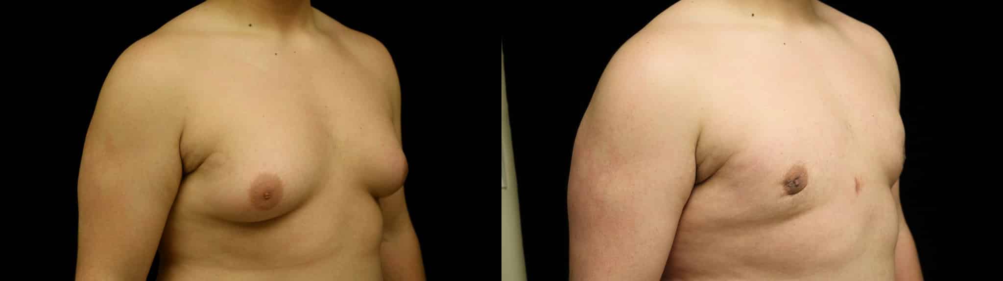 Gynecomastia Patient 5 Before & After Details